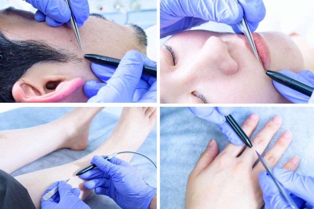 Permanent electrolysis hair removal at ReMove salon in Kashiwa, Chiba, Japan. top image