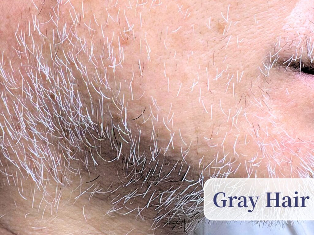 Permanent electrolysis hair removal at ReMove salon in Kashiwa, Chiba, Japan. top image