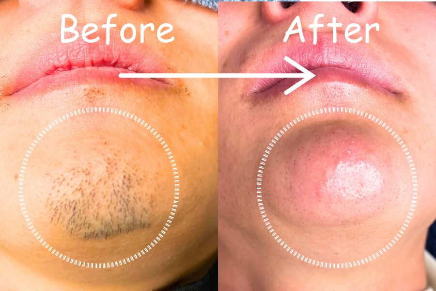 美容電気脱毛（ニードル脱毛）によるあご髭の永久脱毛。男性