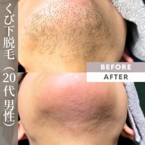 ニードル脱毛。顎下の永久脱毛