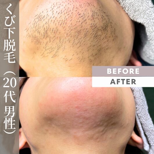 ニードル脱毛。顎下の永久脱毛